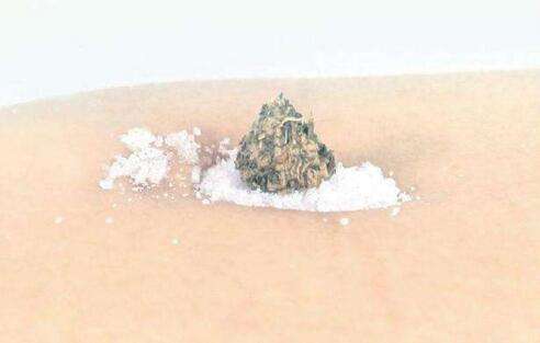 痛经针灸穴位疼不疼,痛经针灸完还是很痛