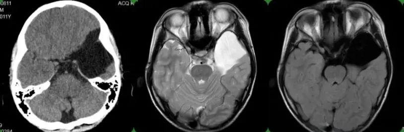 小孩发育脑部囊肿,小孩蛛网膜囊肿会影响智力发育吗