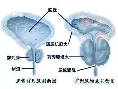 前列腺增生微创钬激光手术,前列腺微创钬激光