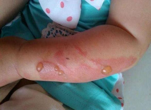 孩子被烫伤如何做心理疏导,小孩被烫伤最佳处理方法