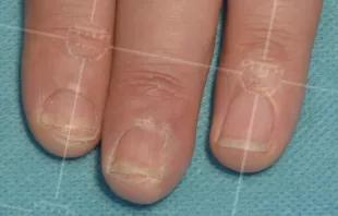 美甲会不会导致灰指甲,灰指甲脱甲液致癌