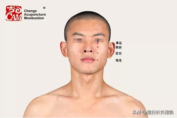 面瘫面神经炎中医调理方法,面神经炎中医针灸穴位图片