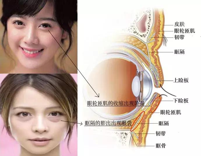 卧蚕和眼袋到底怎么区分？