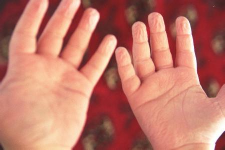 手指反复脱皮是怎么回事该怎么办,手指老是会脱皮是怎么回事