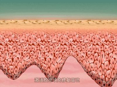 红痘印和红痘痘怎么祛,祛痘疤痘印痘坑最有效的方法