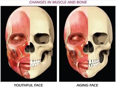 法令纹和苹果肌下垂哪个更显老,脸上肉多但是下垂