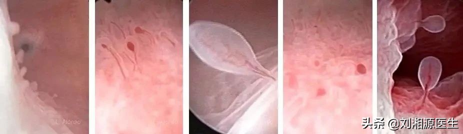 「免疫相关不良妊娠答疑解惑39」——子宫内膜炎