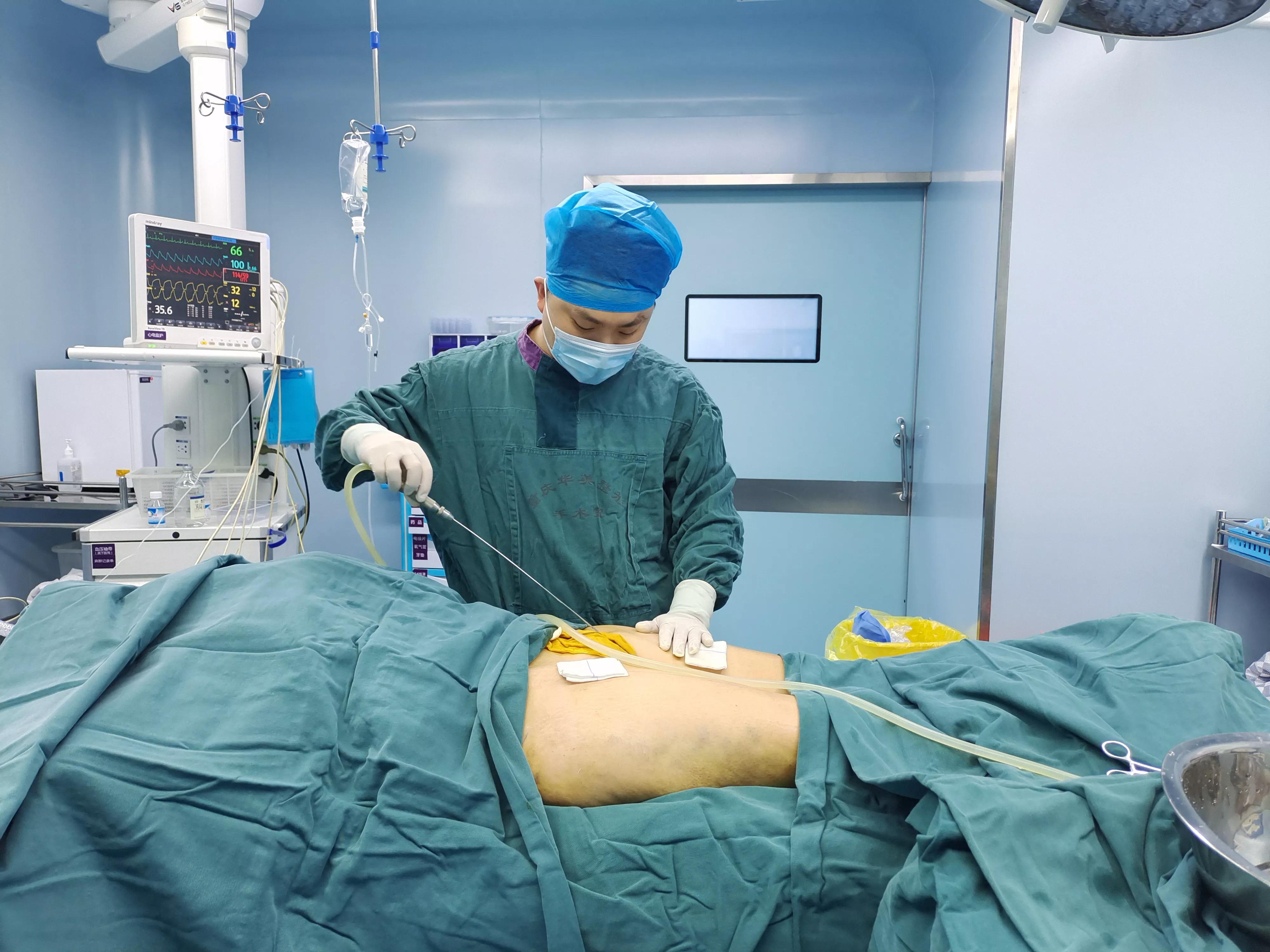 大腿吸脂手术多少钱权威李春财,大腿吸脂手术多少钱优秀李春财