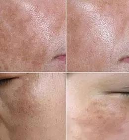 脸部斑的种类及如何辨别,一招教你怎样辨别脸上的斑