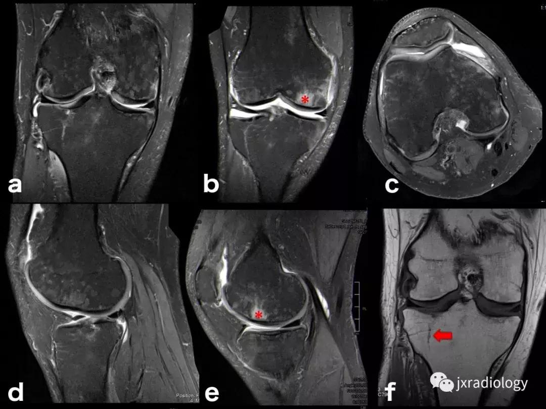 磁共振骶髂关节骨髓水肿是强直吗,磁共振显示骨髓水肿什么意思