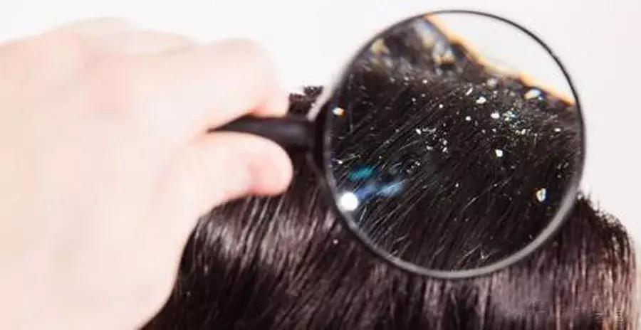 顽固头屑是什么真菌,真菌性头屑怎么消除