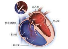先心病是孕期怎么形成的,先心病儿童平常需要注意什么