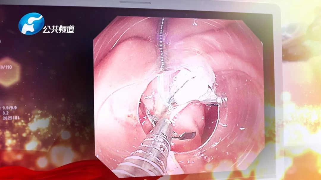 郑大一附院消化病院院长刘冰熔和他的NOTES技术：为国争光何惧苦累！