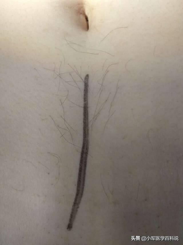 手术前剃头好吗,手术前为什么要刮肚子上的毛