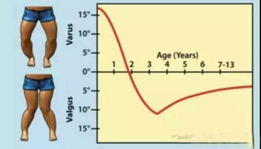 孩子的腿不直怎么办,为什么孩子腿不伸直