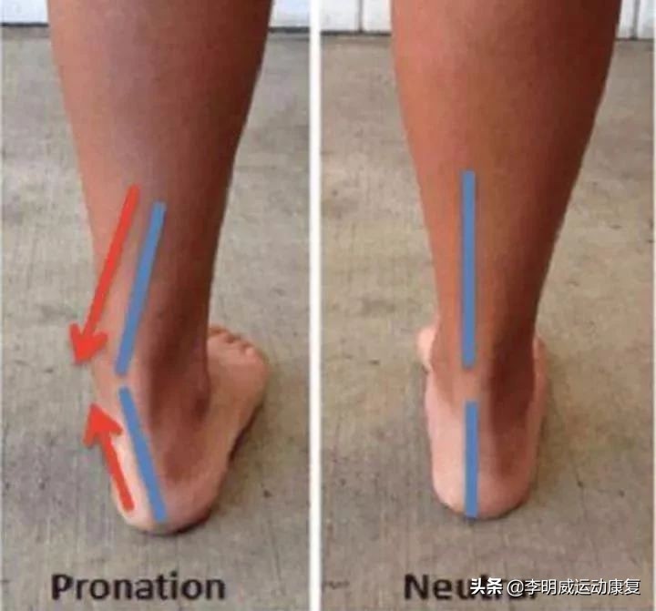 足外翻能不能治愈,足外翻能自己长好吗