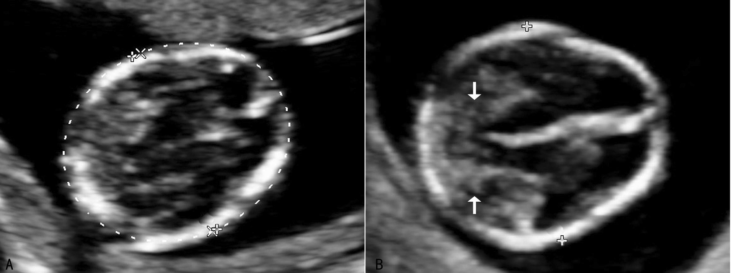 胎儿神经系统发育异常的超声表现,胎儿中枢神经系统超声检查视频