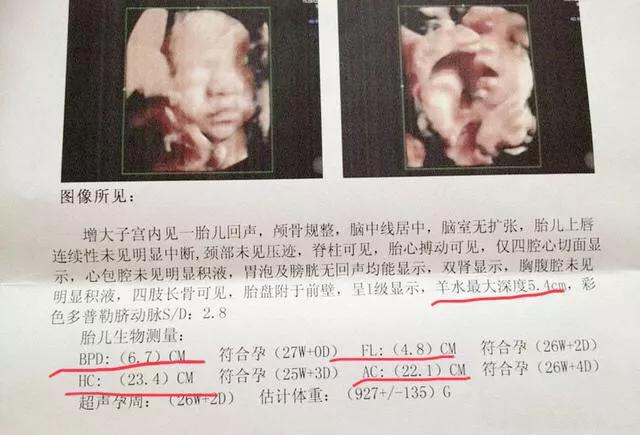 胎儿如何检查智力发育,b超单怎么看出胎儿boy还是girl