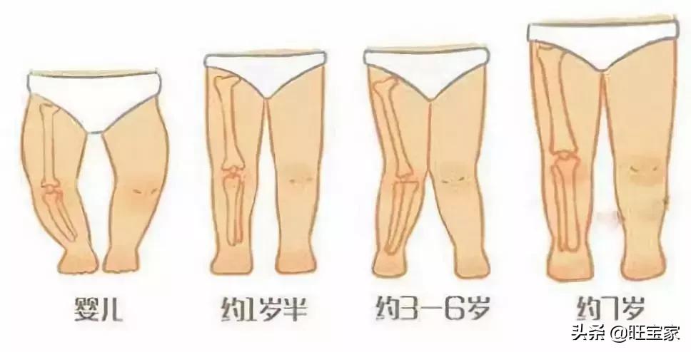 林允儿的o型腿,林允儿的o型腿走路