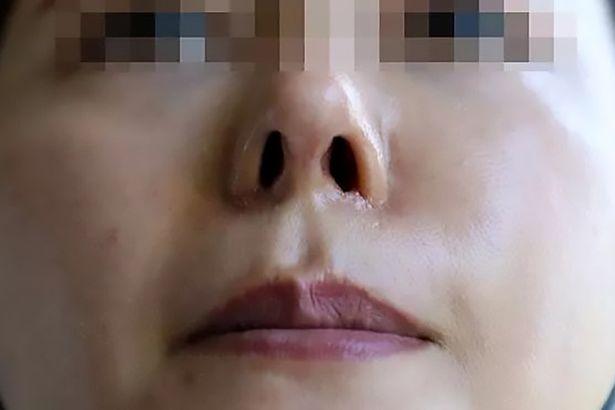 一女子整容成熊猫鼻,泰国妹子花150万整容