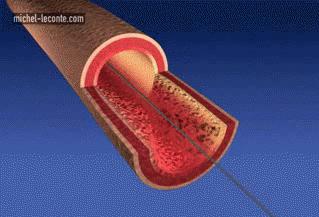 不想支架有必要做造影吗,不想脑出血脑梗心梗要注意什么