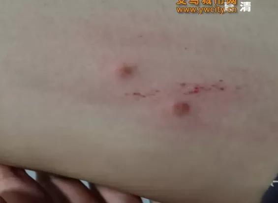 去了海边之后长了小红疹,去海边没暴露的地方起疹子