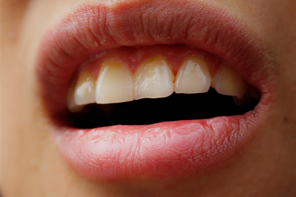 老是嘴巴干喝水也不管用,喉咙发干喝水也不能缓解