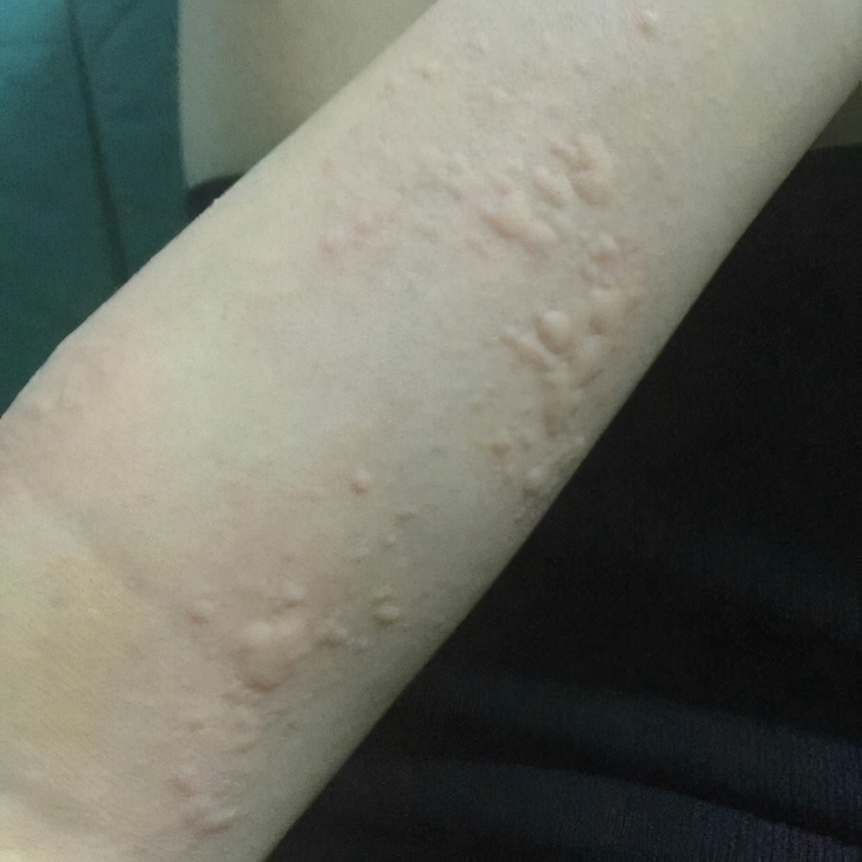 挠荨麻疹,荨麻疹尽量别挠