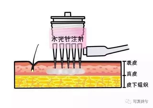便宜的1000多，贵的10000起步，祛斑套餐的差距咋这么大？