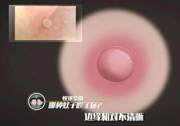 三种常见蚊子咬的包如何快速止痒消除，三种被叮的包要分清楚