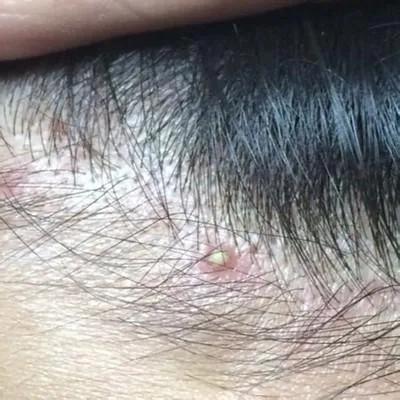 头皮穿凿性毛囊炎如何根治,头皮毛囊炎可以根治吗该如何治疗