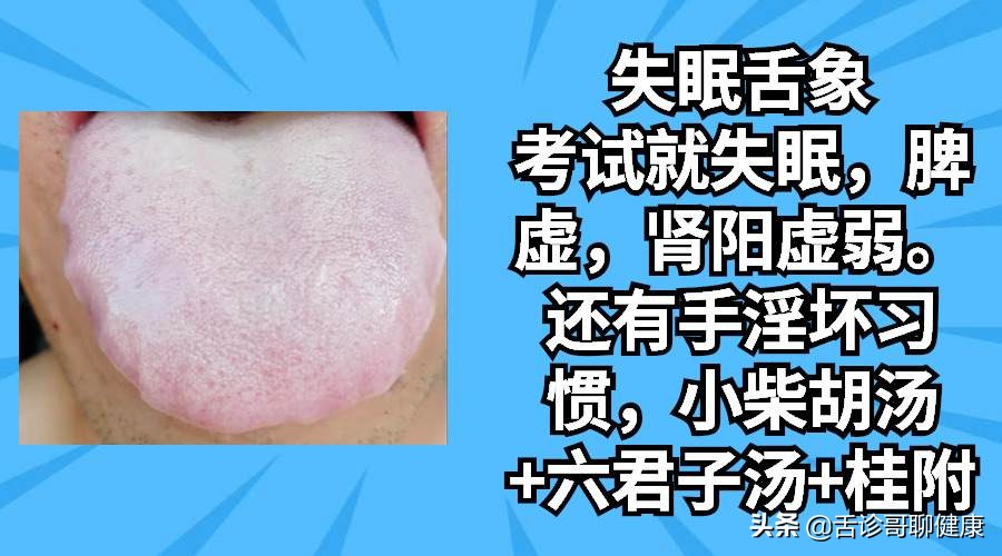 舌诊哥:遗精滑精、气短、虚汗、紧张、焦虑等舌象分析