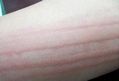 人工性荨麻疹是什么原因导致的,人工性荨麻疹是怎么造成的