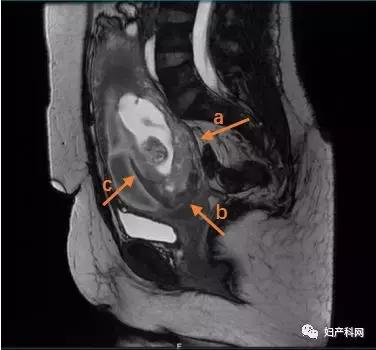 介入手术后胎盘植入还会大出血吗,孕中期胎盘植入手术的风险