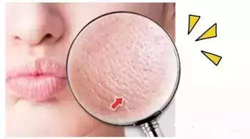皮肤粗糙毛孔粗大,毛孔粗大黑头顽固