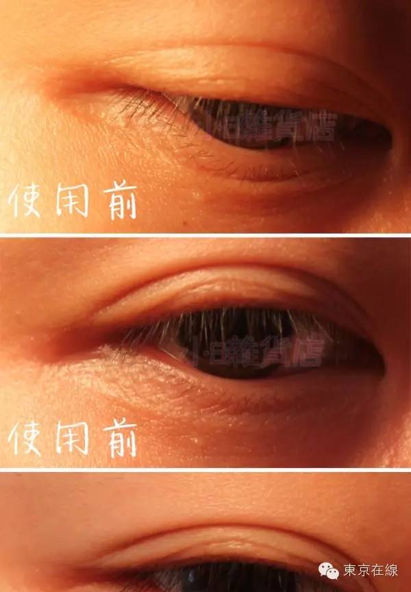 日本spa蛇毒眼膜,日本抗皱蛇毒眼膜