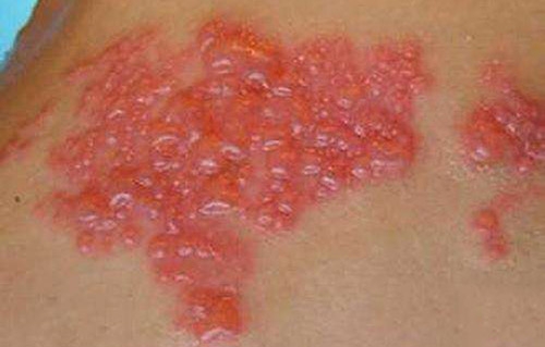 治疗带状疱疹用哪几种药配合最好,带状疱疹治疗方法及用药注意事项