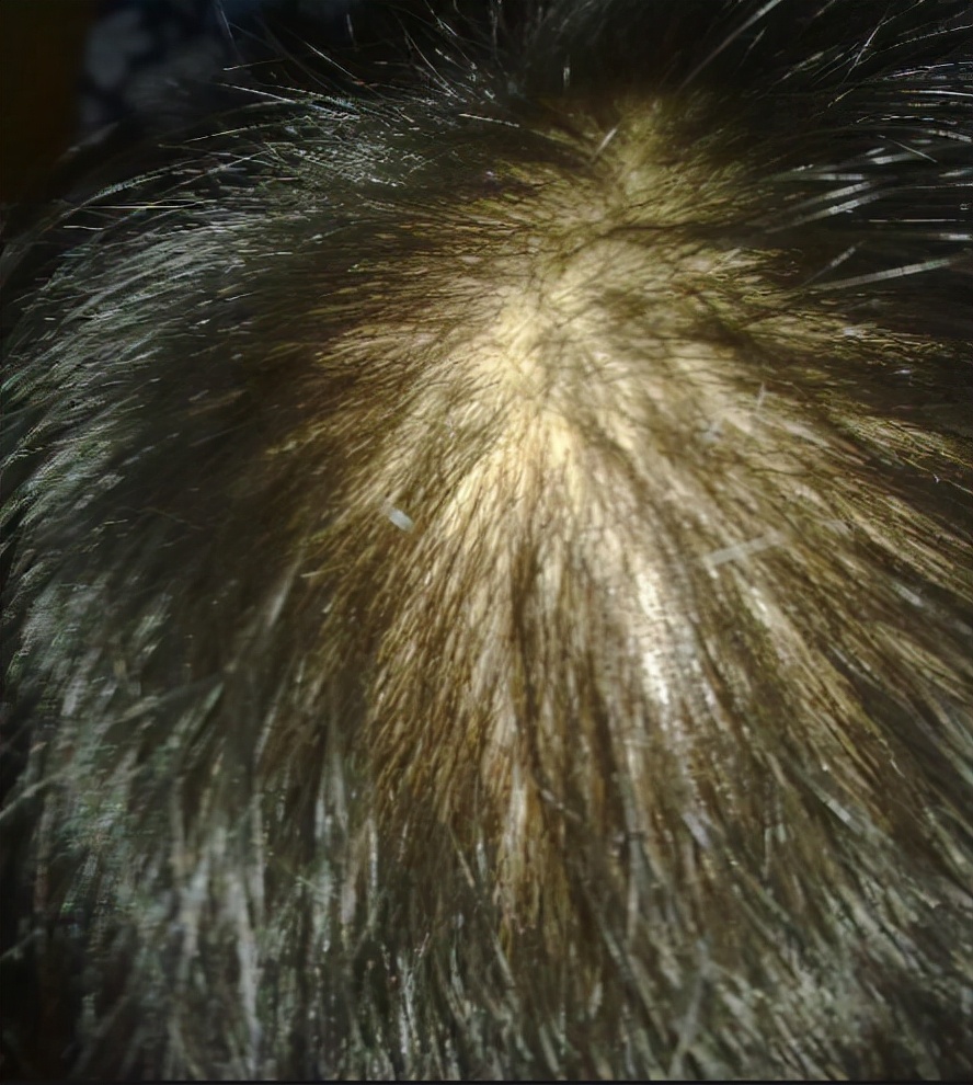 非那雄胺治疗雄激素脱发,雄激素脱发只吃非那雄胺有效果吗