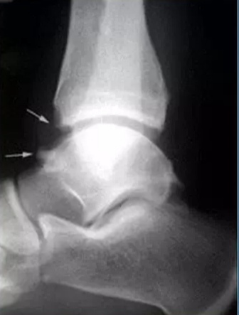 踝关节背屈角度受限疼痛,前踝与后踝撞击