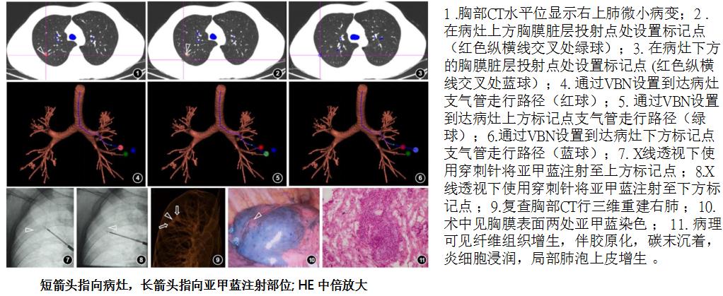孙加源门诊,治疗肺癌的新技术新手段