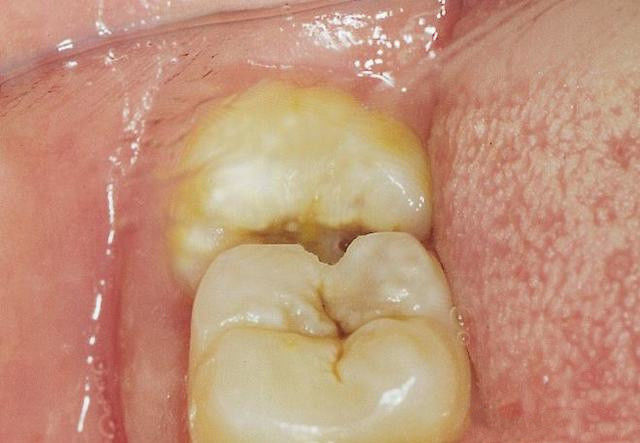 拔智齿会引起邻牙松动吗,拔智齿会导致其他牙齿松动吗