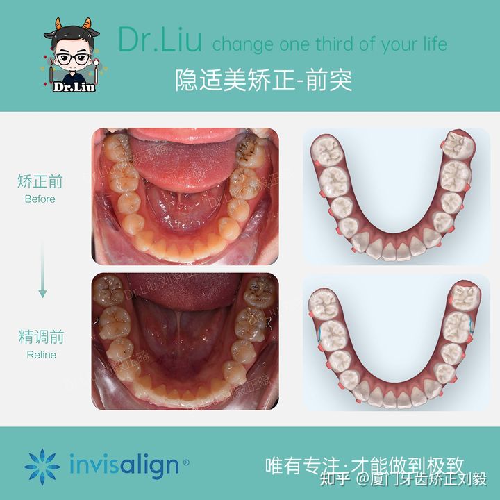 牙齿矫正厦门口腔医院,厦门隐形龅牙矫正优惠