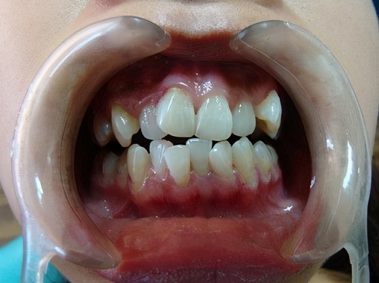 上海牙齿松动怎么修复,牙齿松动不适怎么解决