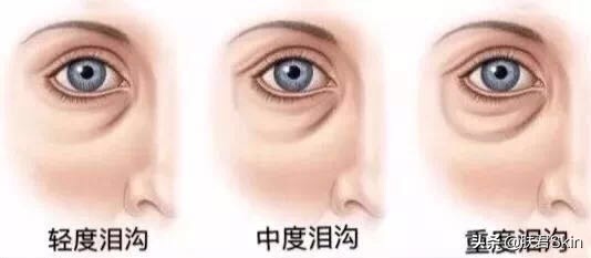 有什么沟必须火的,泪沟后面有一条很深的沟叫什么