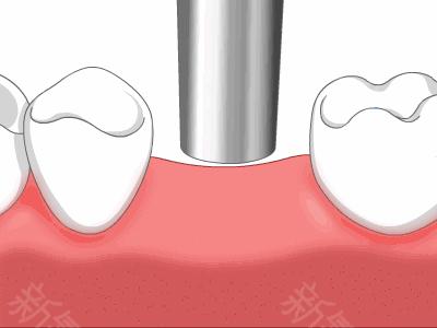 种植牙和烤瓷牙的利弊有哪些,种植牙和烤瓷牙的区别哪个更坚固
