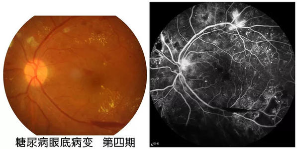 糖尿病患者出现这种眼病要重视
