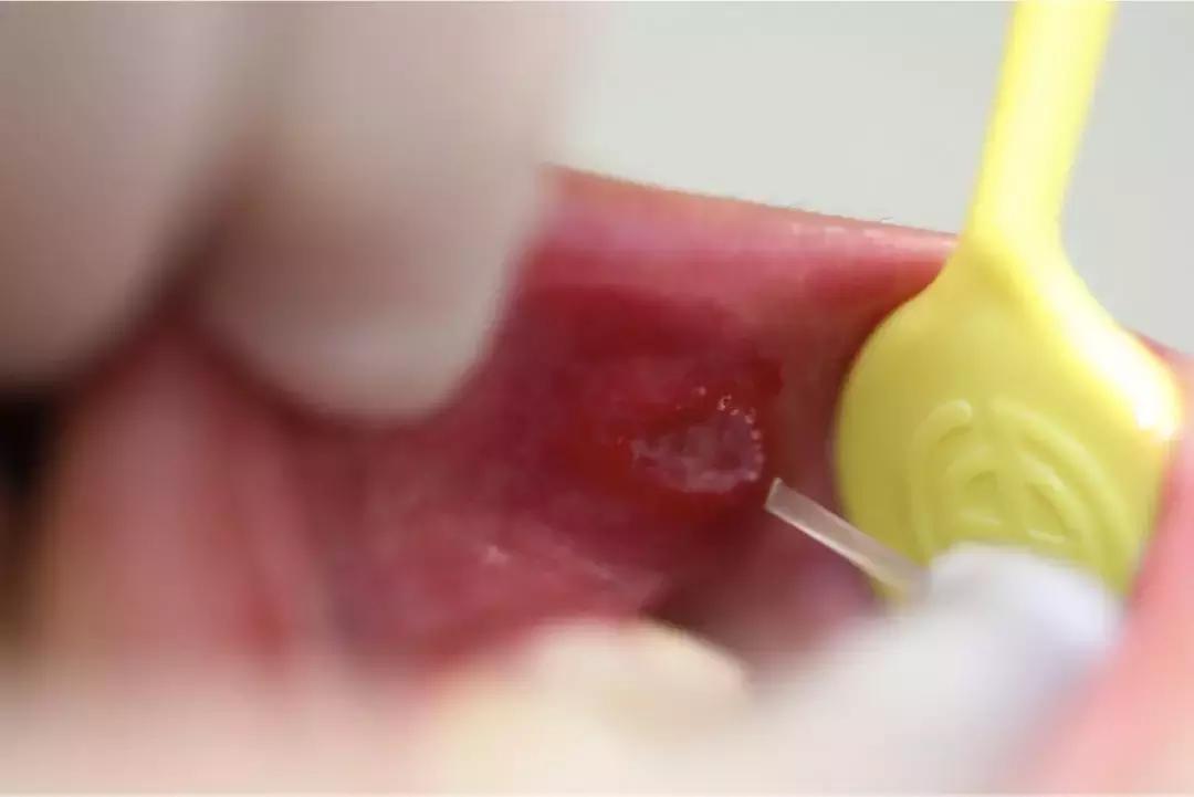 更年期反复口腔溃疡怎么调理,女性反复口腔溃疡是大病前兆