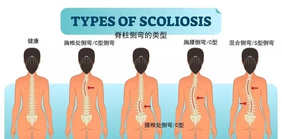 9岁小孩脊柱侧弯怎么补救,十岁孩子脊柱侧弯的照片