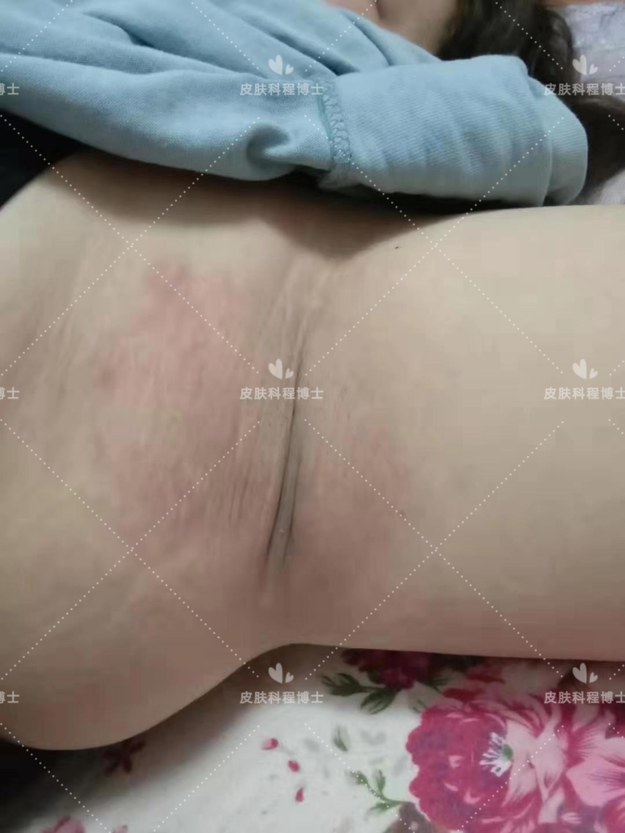 狐臭女孩真实案例,女博主腋臭手术