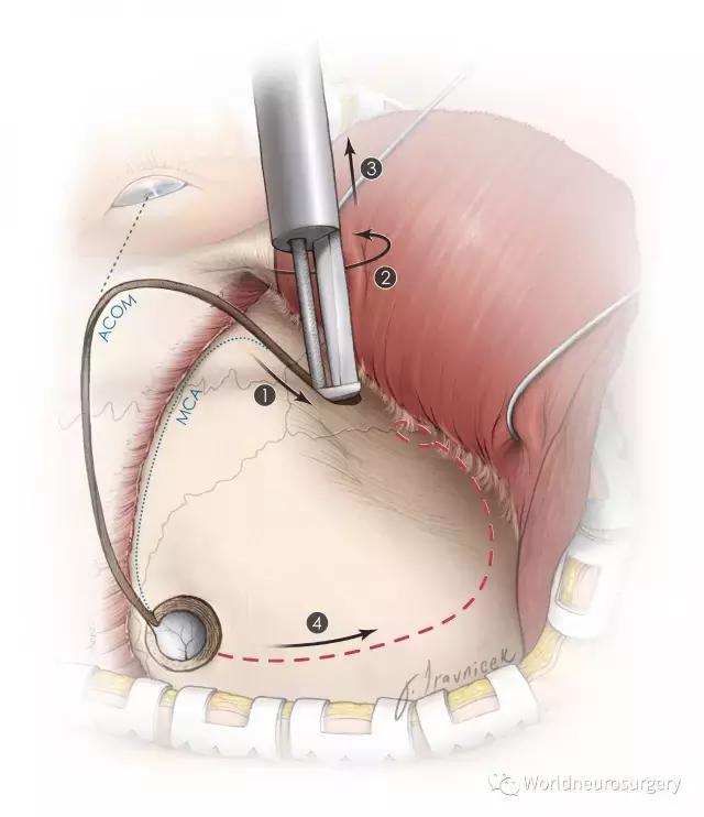 翼点入路的开颅要点,翼点开颅详解图
